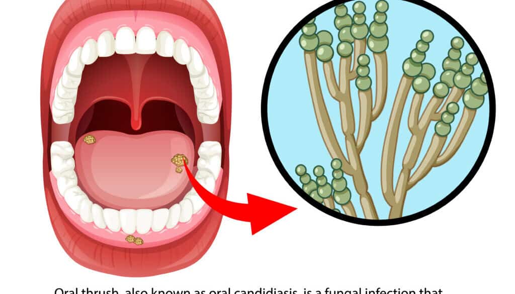 Illustration of an open mouth with white spots on the tongue, indicating oral thrush; inset shows a close-up of Candida fungus, with descriptive text about oral candidiasis.