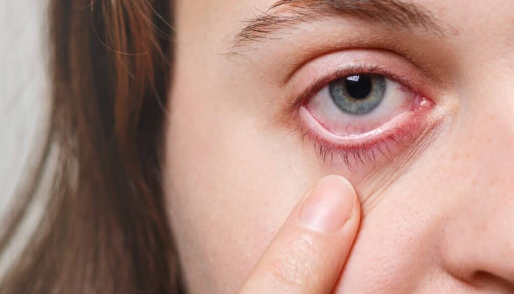 A close-up of a person's face showing a blue eye with redness and irritation. A finger gently pulls down the lower eyelid, highlighting the inflamed area.