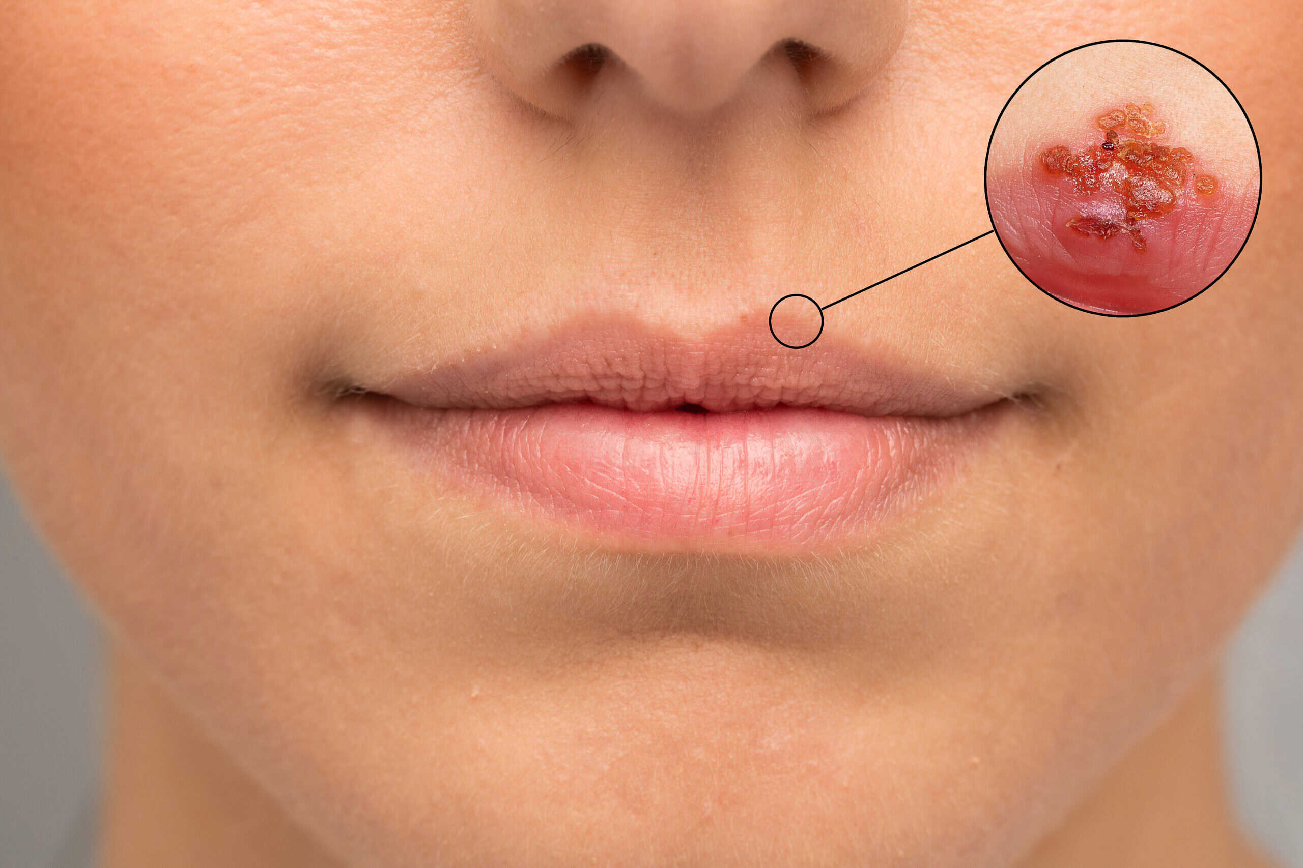 Close-up of a person’s lips with a blister on the upper lip. An inset magnifies the blister, showing clustered red sores with yellowish crust, typical of a cold sore.
