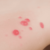 Close-up of red, raised itchy hives on skin, showing irritation and discomfort from an allergic reaction.