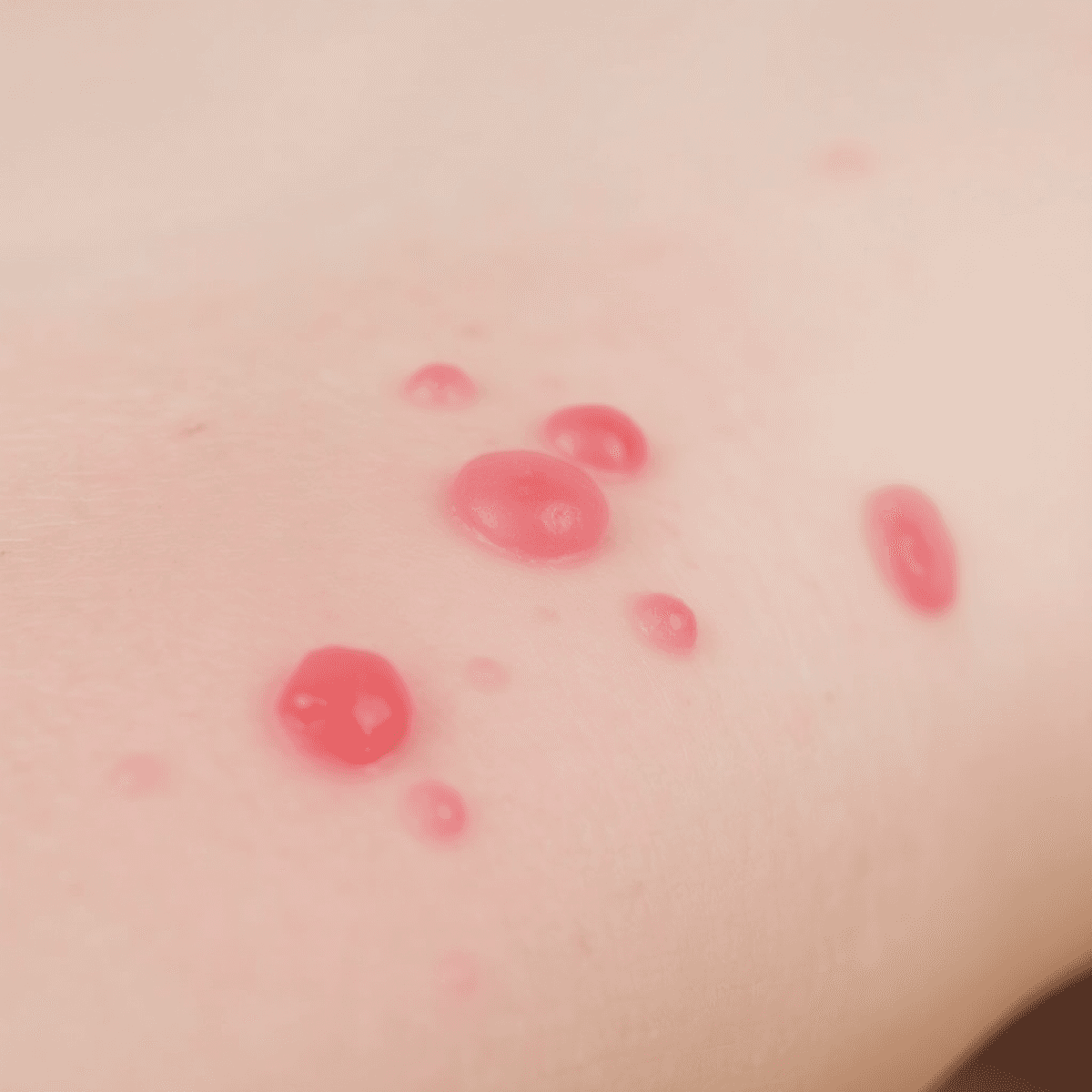 Close-up of red, raised itchy hives on skin, showing irritation and discomfort from an allergic reaction.