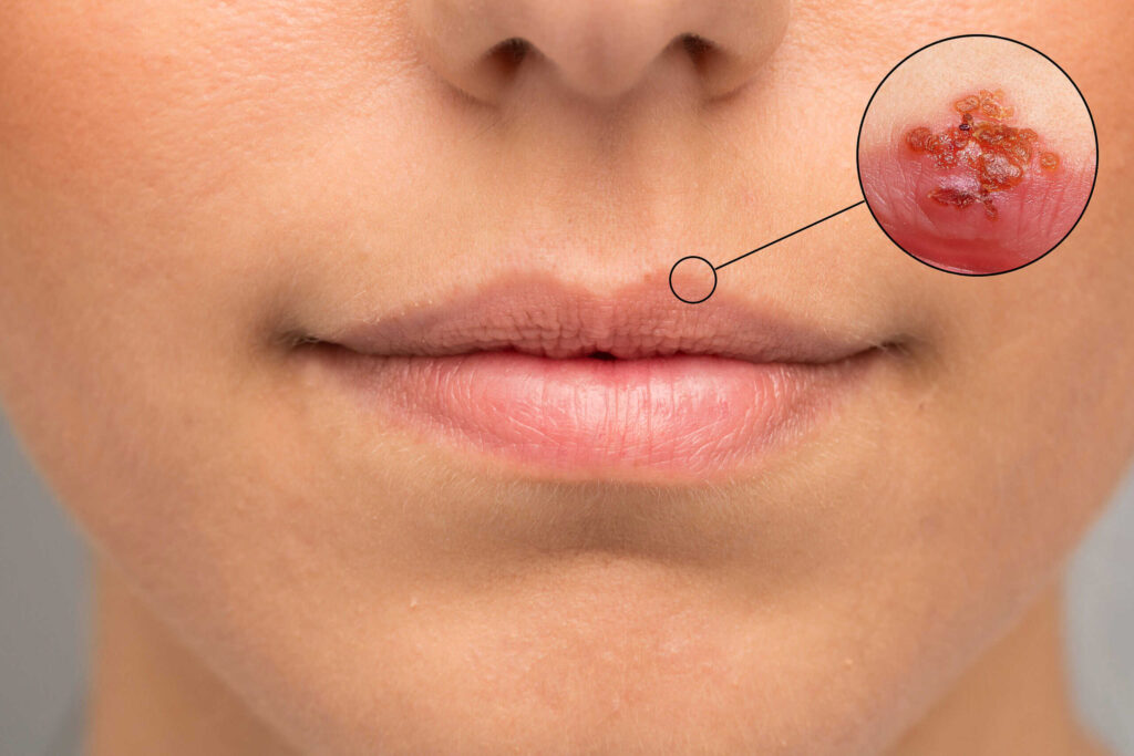 Close-up of a person’s lips with a blister on the upper lip. An inset magnifies the blister, showing clustered red sores with yellowish crust, typical of a cold sore.