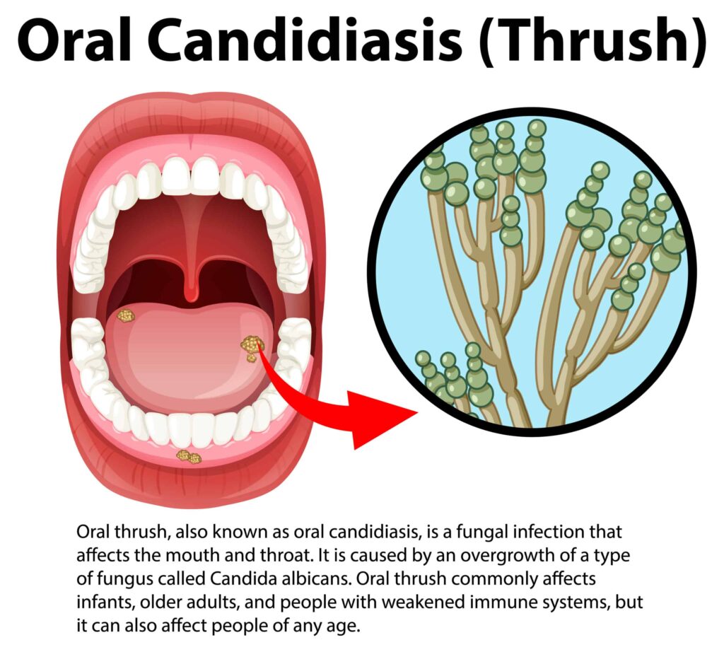 Illustration of an open mouth with white spots on the tongue, indicating oral thrush; inset shows a close-up of Candida fungus, with descriptive text about oral candidiasis.