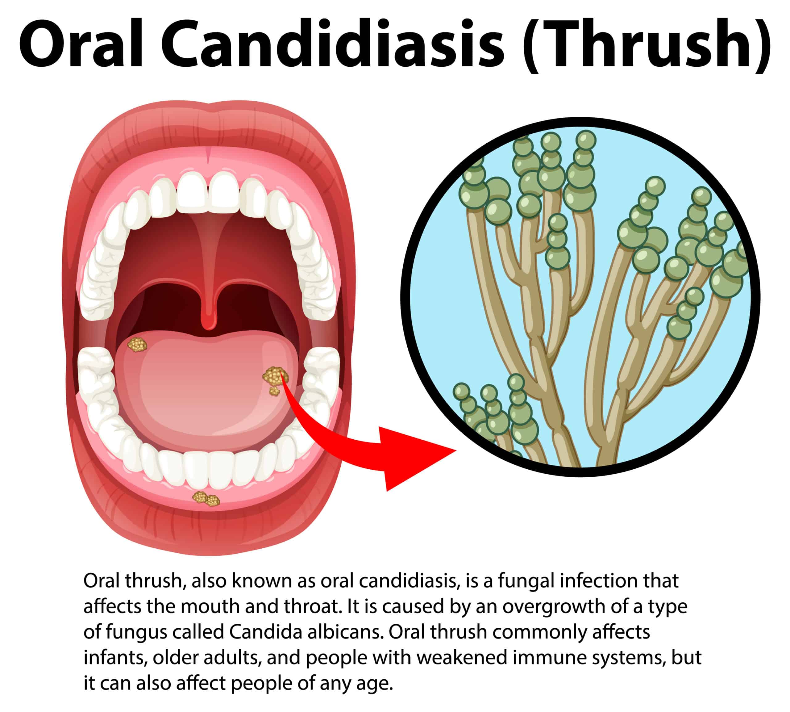 Illustration of an open mouth with white spots on the tongue, indicating oral thrush; inset shows a close-up of Candida fungus, with descriptive text about oral candidiasis.
