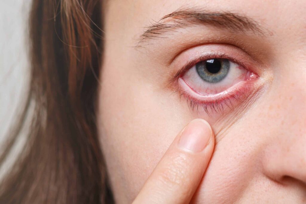 A close-up of a person's face showing a blue eye with redness and irritation. A finger gently pulls down the lower eyelid, highlighting the inflamed area.